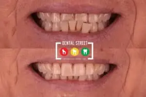 two photos in comparison the works of Dental Street in aligning the teeth