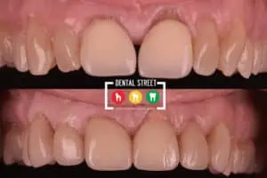 Before and after photos of Invisalign treatment in Brownsville TX