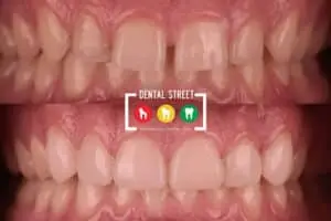 two photos in comparison the works of Dental Street in fixing gap of the teeth