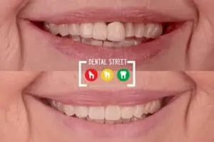 Before and after photos of teeth that got fixed through restorative dentistry