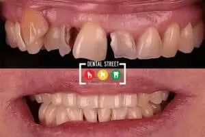 Before and after photos of severly damaged teeth that received restorative dentistry in Brownsville TX