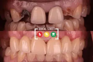 Before and after photos of sever tooth decay now looking healthy after receiving treatment at Dental Street