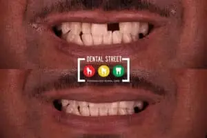 Before and after photos of a set of teeth where a missing tooth has been replaced