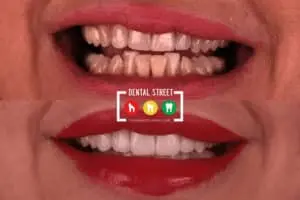 two photos in comparison the works of Dental Street in aligning the teeth