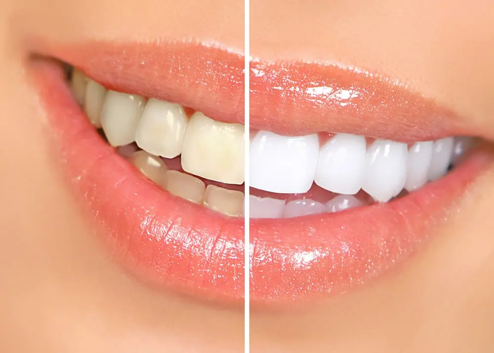 Photo showing before and after professional teeth whitening