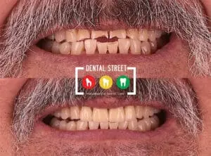two photos in comparison the works of Dental Street in aligning the teeth