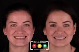 Before and after photos of a woman showing that the gaps between her teeth closed with veneers and digital smile design