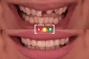 Before and after photos of damaged, cracked, and broken teeth now looking radiant and healthy