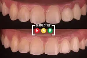 Before and after photos of teeth that received quality, affordable treatment at Dental Street in Brownsville TX