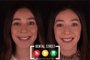 Before and after photos of a woman showing her new radiant smile and set of teeth