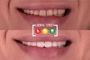 Before and after photos as a result of professional teeth whitening in Brownsville, TX