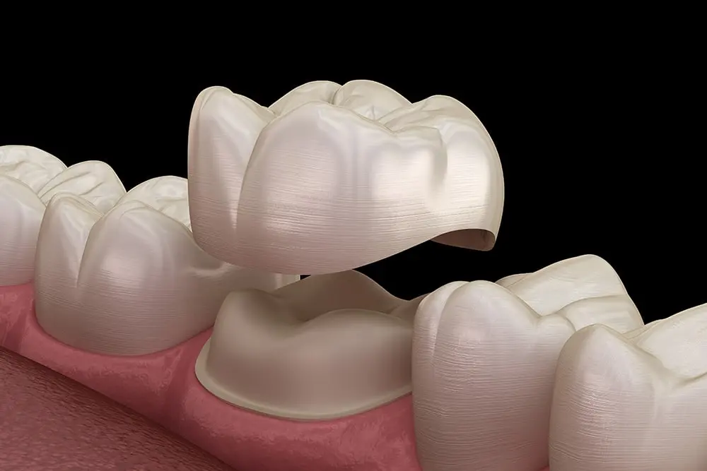 Render of a dental crown placed on a tooth to improve and restore teeth