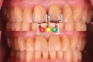 Before and after photos of a set of teeth showing the importance of restorative dentistry