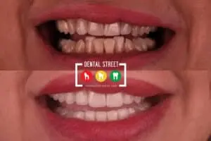 two photos in comparison the works of Dental Street in aligning the teeth