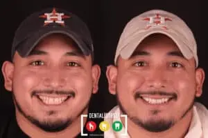 Before and after photos of a man showing his new smile after a smile makeover