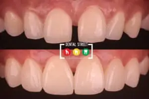 Before and after photos of teeth with a gap, showing the importance of invisalign orthodontics