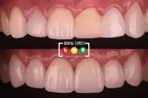 Before and after photos of a set of teeth, showing the importance of cosmetic dentistry