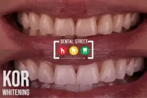 Before and after photos of a set of teeth after receiving Kor teeth whitening