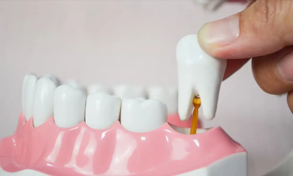 Image of a teeth model showing a tooth extraction at the dentist