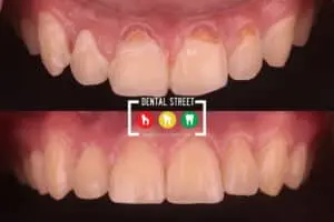two photos in comparison the works of Dental Street in Cleaning of the teeth