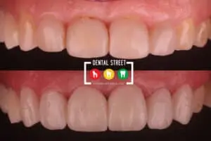 Before and after pictures of a set of teeth with dental veneers