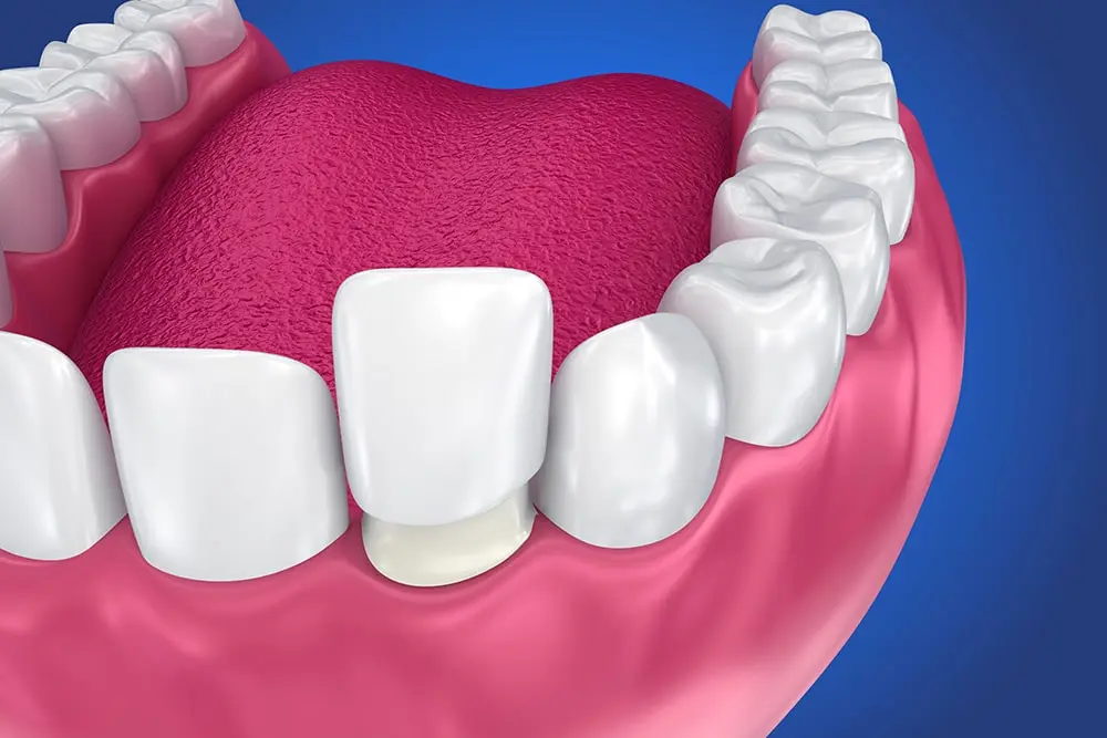 Render of dental veneer being placed on a teeth to enhance a smile
