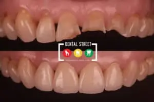Before and after photos of damaged teeth now looking healthy and radiant