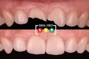 Before and after photos showing how fractured front teeth got fixed at the dentist