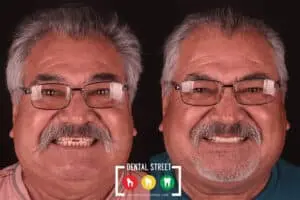 Before and after photos of a man showing his new, radiant smile and teeth in Brownsville TX