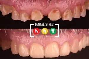 two photos in comparison the works of Dental Street in crowning the teeth