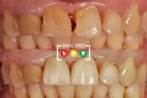 two photos in comparison the works of Dental Street in fixing crack of the teeth