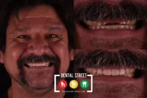 Before and after photos of a man showing his teeth reconstruction with digital smile design