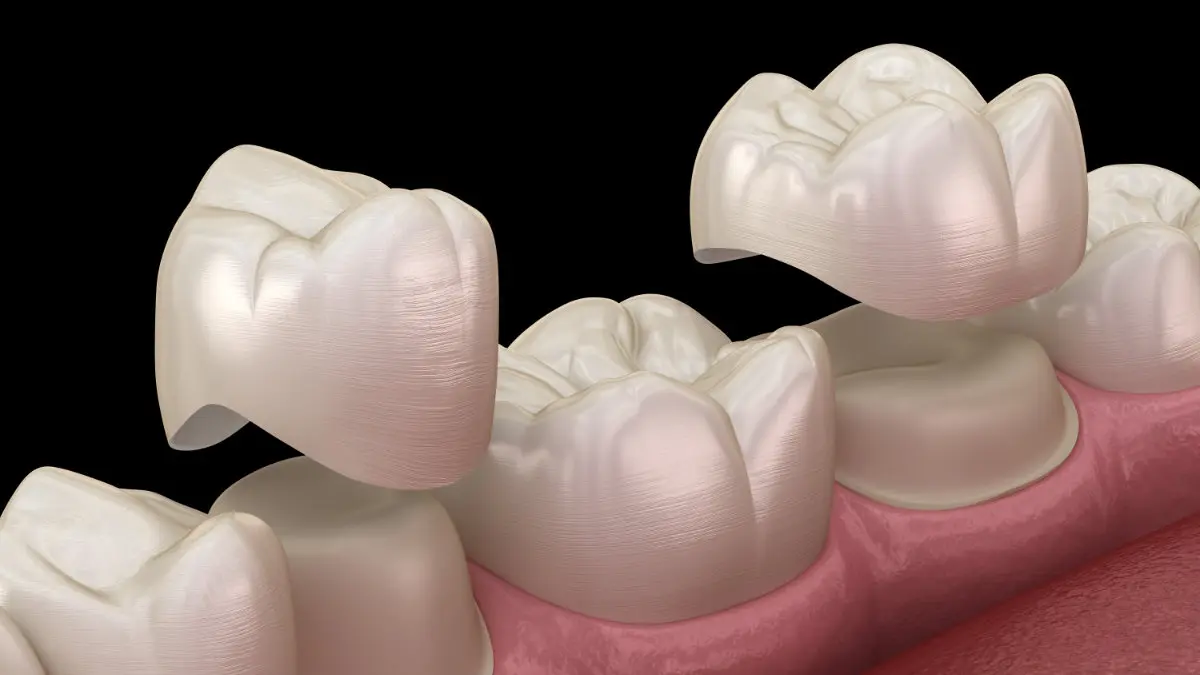 Illustration of dental crowns placed over premolar and molar for restoration