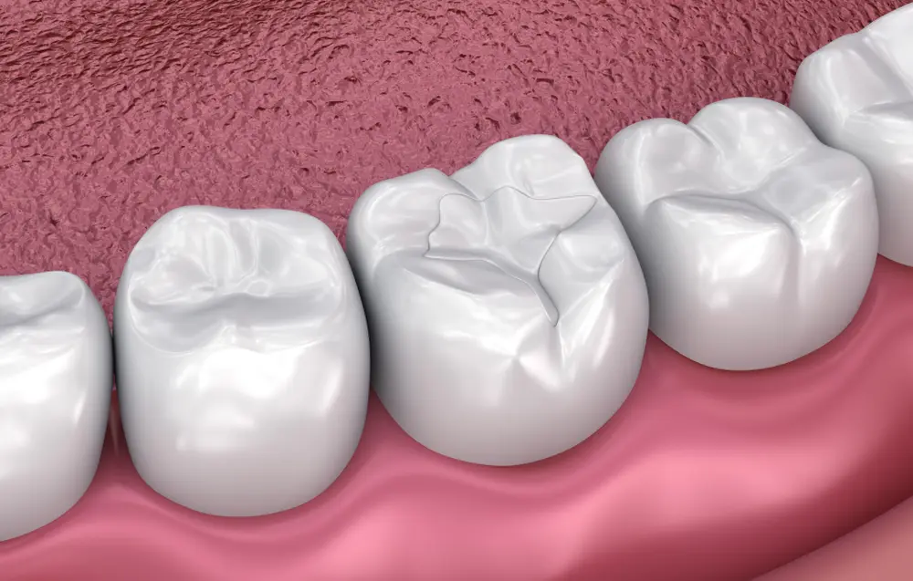 Dental sealant illustration showing protective coating on molar