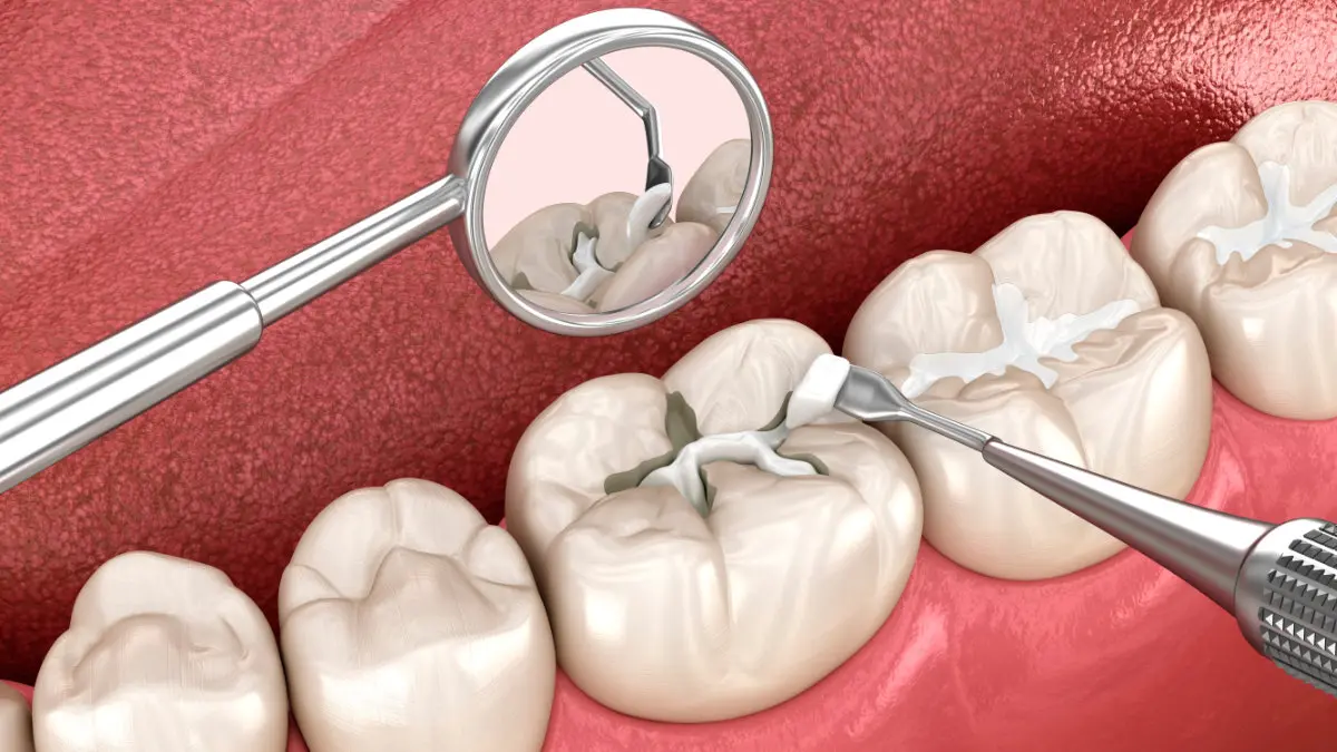 Dental bonding treatment illustration demonstrating cosmetic tooth repair