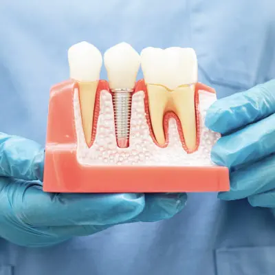 Close-up of dental implant model demonstrating tooth replacement