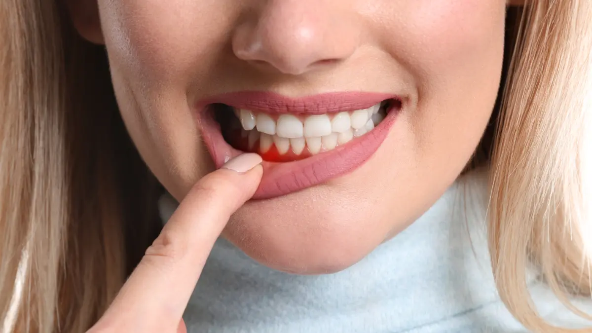 Woman pointing to inflamed gums, indicating need for endodontic treatment