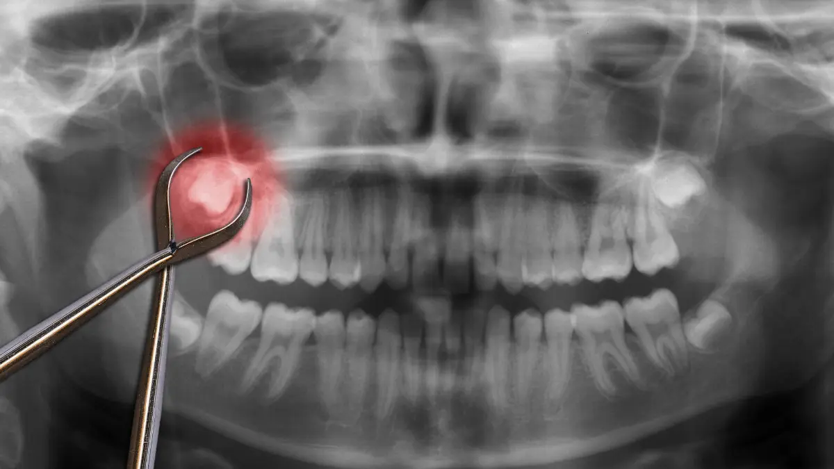 Dental X-rays showing wisdom teeth before extraction
