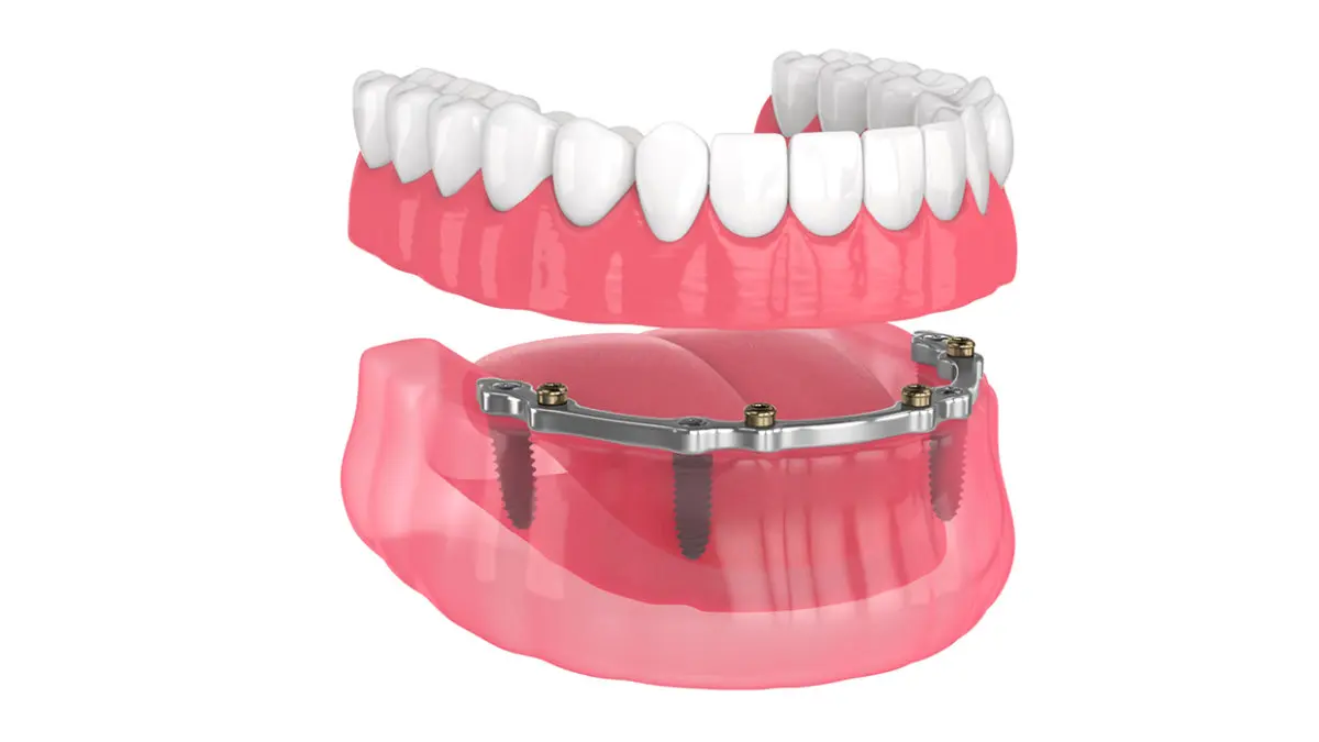 All-on-4 implant dentures illustration showing full arch tooth replacement