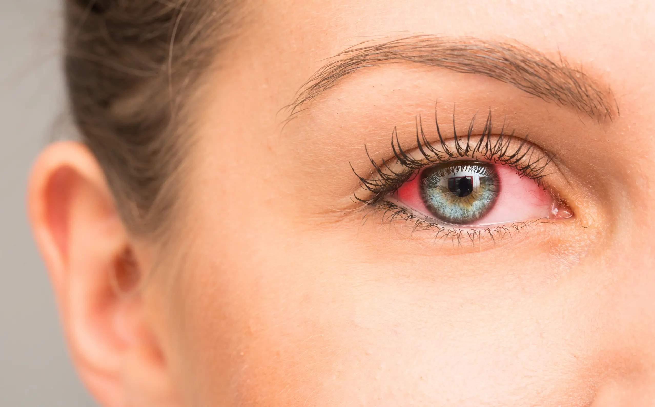 Eye infection care