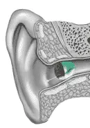 Invisible in the Canal Hearing Aid