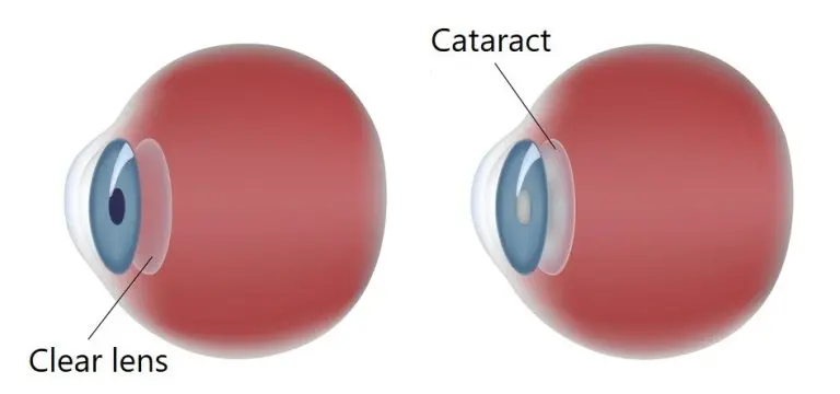 Graphic cross-section showing two eyes for comparison, one with a clear lens and one with a cataract