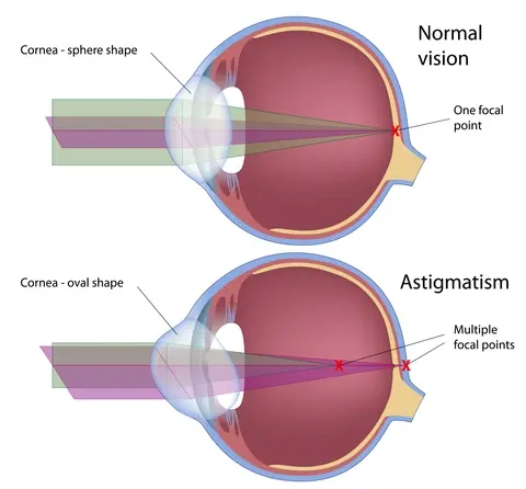 Graphic. Cross-section of eye. Normal vision vs astigmatism. The oval shape of the cornea in astigmatism causes multiple focal points on the retina when their should be only one focal point.