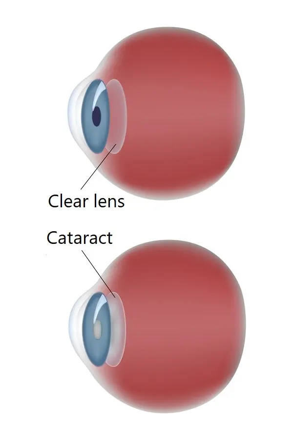 Graphic cross-section showing two eyes, horizontally positioned, for comparison, one with a clear lens and one with a cataract.
