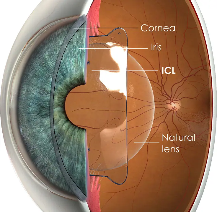 Eye diagram showing the cornea, iris, ICL (Intraocular Contact Lens), and natural lens