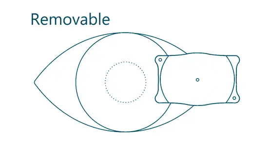 Benefit of ICL lenses #4: removable lenses