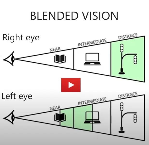 Video Thumbnail: Blended Vision - Illustration showing the effect in both right and left eyes.