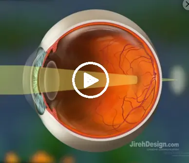 Click on the image to open a 30 second video that explains hyperopia.