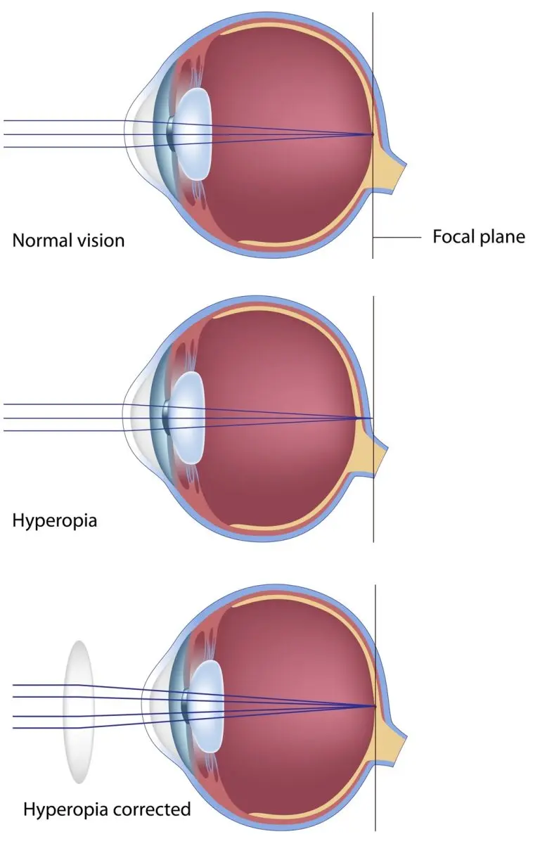 Graphic showing three eyes, illustrating the focal plane across normal vision, hyperopia, and hyperopia corrected.