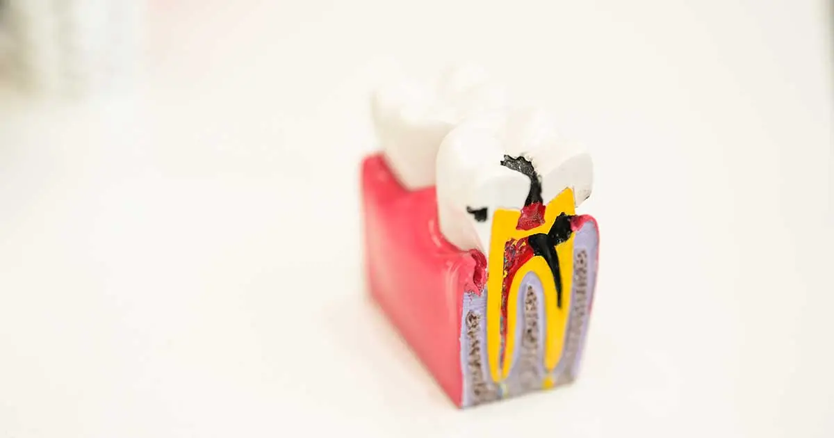 The Root Canal Debate: Risks & Alternatives